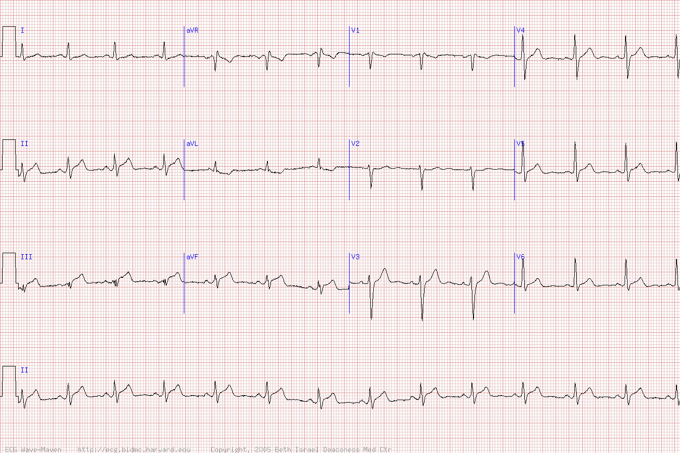 Rv Infarct